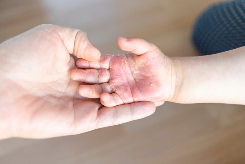 Khi Mơ Thấy Bị Bỏng Vào Tay Nên Đánh Con Gì Khi Mơ Thấy Bị Bỏng Vào Tay Nên Đánh Con Gì